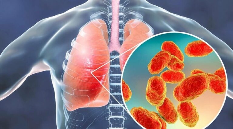 Скільки днів тримається температура при запаленні легень