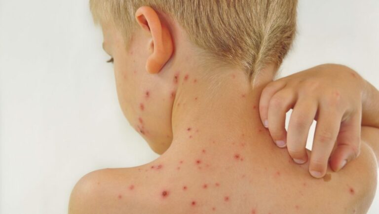 Через скільки днів після зараження проявляється вітрянка?