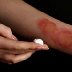 Лікування опіків після променевої терапії: детальний гайд для швидкого відновлення