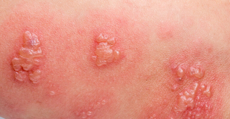 Чим мастити оперізуючий лишай: дієві засоби та догляд