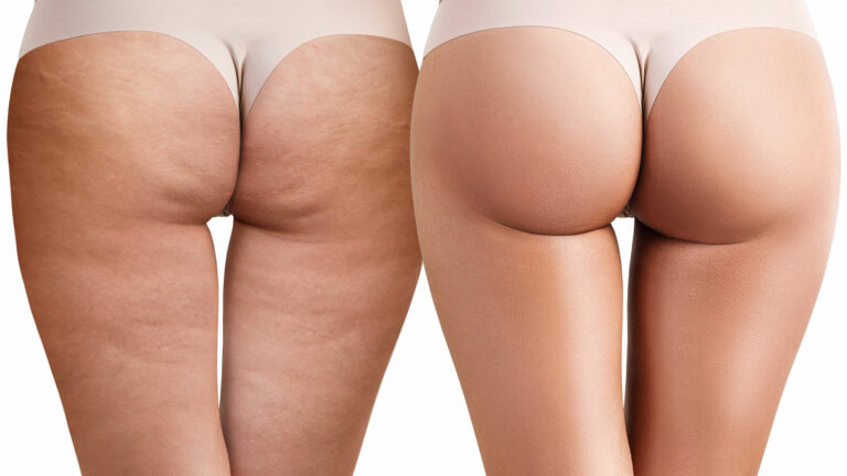 Найкращі способи позбутися целюліту: ефективні методи 2026