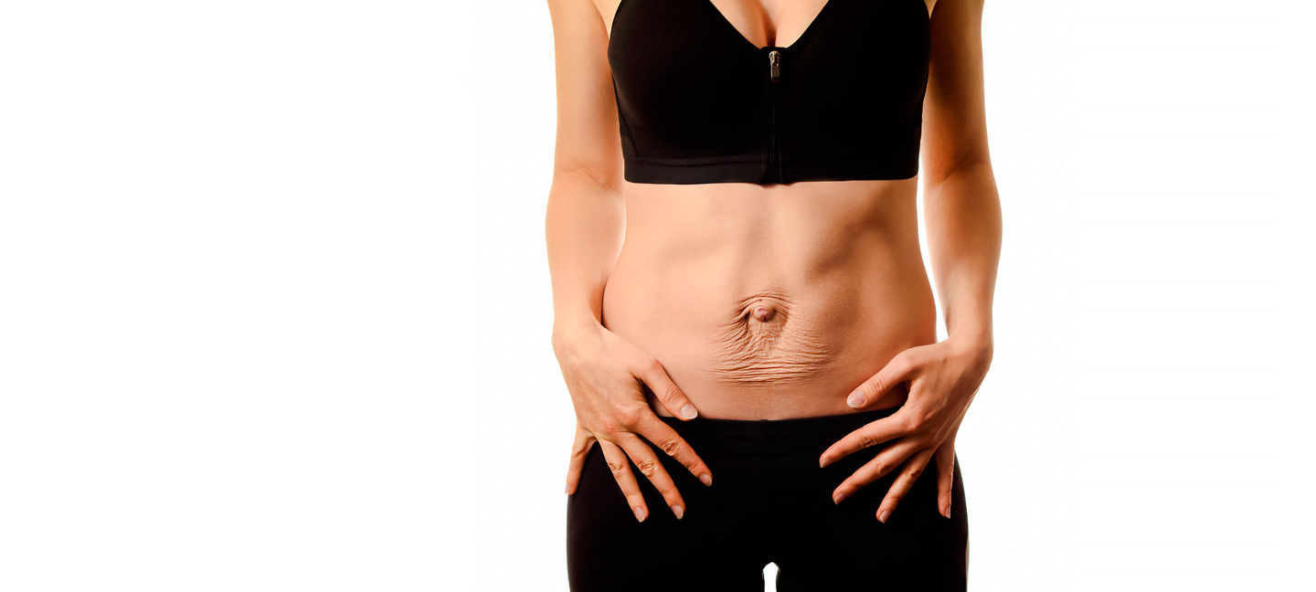 Діастаз прямих м’язів живота: що це та як з цим жити