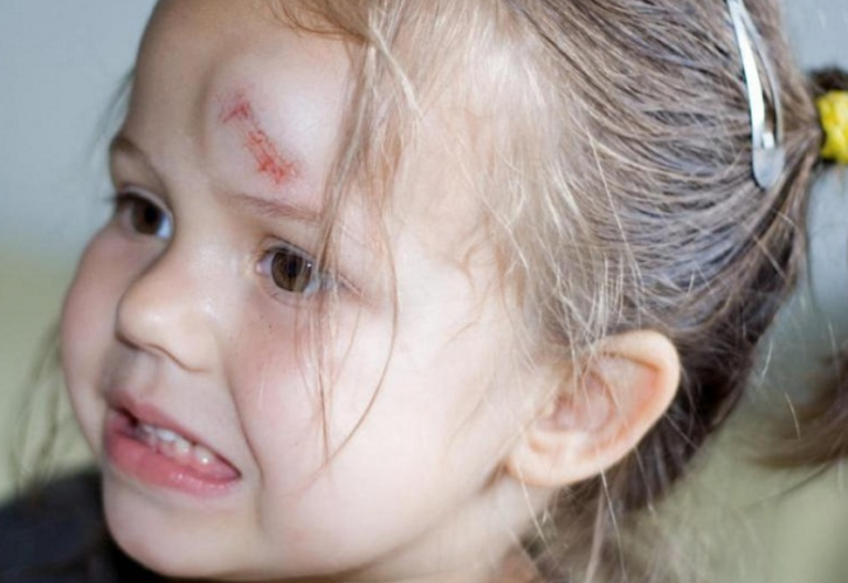 За скільки часу сходить шишка на голові: детальний гід по загоєнню