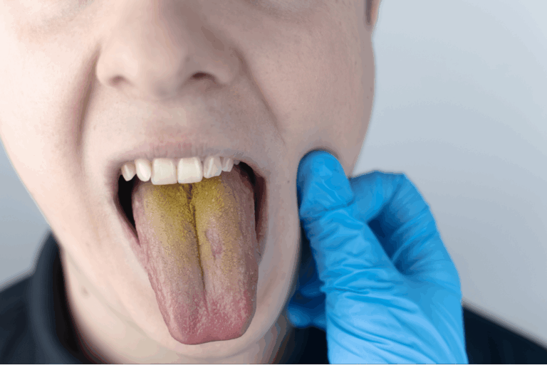 Чому жовтий язик: причини нальоту та шляхи швидкого очищення