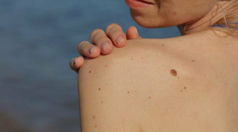 Чи болить меланома: симптоми, стадії болю та порятунок на часі