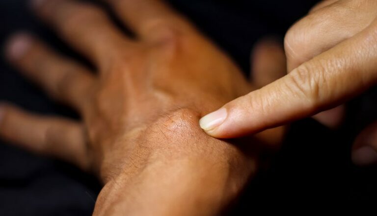 Чому болить гігрома: причини болю та що з цим робити