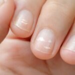 Білі плями на нігтях: чому з’являються та як їх позбутися
