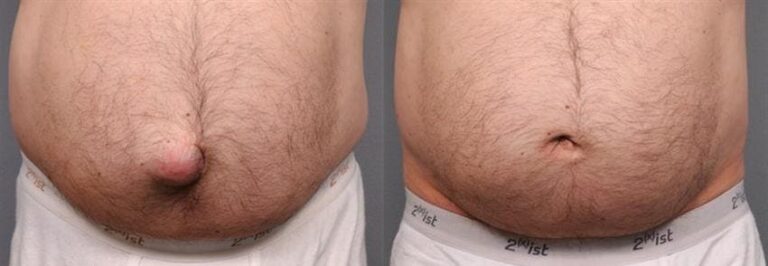 Як позбутися пупкової грижі без операції: реальні шляхи