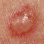 Як виглядає базаліома: фото-приклади та детальний опис