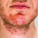 Як лікувати себорейний дерматит на обличчі: детальний план дій