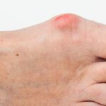 Як зняти запалення кісточки на нозі: детальний посібник