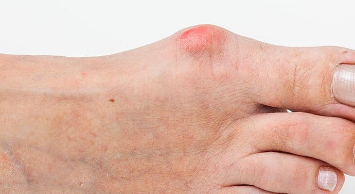 Як зняти запалення кісточки на нозі: детальний посібник