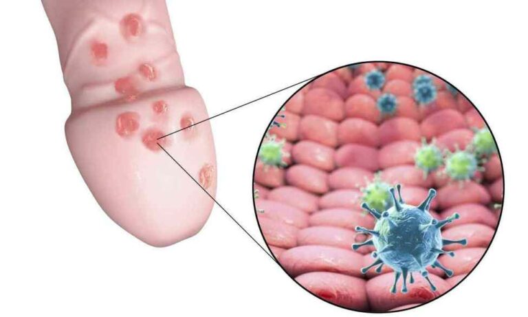 Папіломи на статевих органах: детальний опис зовнішнього вигляду